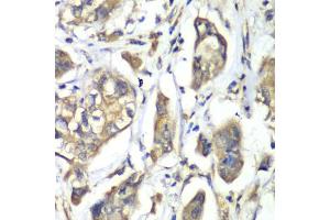 Immunohistochemistry of paraffin-embedded human liver cancer using NFS1 antibody. (NFS1 抗体)