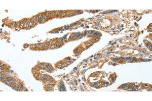 Immunohistochemistry of paraffin-embedded Human colon cancer tissue using CKAP2 Polyclonal Antibody at dilution 1:70 (CKAP2 抗体)