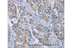 Immunohistochemistry of Human breast cancer using KCNQ5 Polyclonal Antibody at dilution of 1:30 (KCNQ5 抗体)