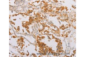 Immunohistochemistry of Human lung cancer using STK40 Polyclonal Antibody at dilution of 1:40