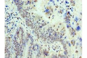 Immunohistochemistry of paraffin-embedded human colon cancer using ABIN7172050 at dilution of 1:100 (THOC1 抗体  (AA 428-657))