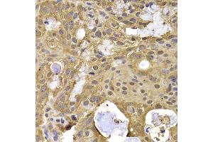 Immunohistochemistry of paraffin-embedded human oophoroma using NAA20 antibody (ABIN5974272) at dilution of 1/100 (40x lens). (NAT5 抗体)