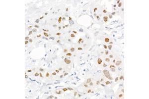 Immunohistochemistry of paraffin-embedded human breast cancer using Phospho-c-Jun-S73 Rabbit pAb (ABIN3023567, ABIN3023568, ABIN3023569 and ABIN6225411) at dilution of 1:25 (40x lens). (C-JUN 抗体  (pSer73))