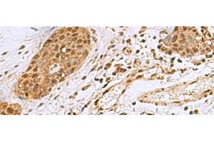 Immunohistochemistry of paraffin-embedded Human esophagus cancer tissue using NVL Polyclonal Antibody at dilution of 1:80(x200) (NVL 抗体)