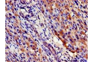 Immunohistochemistry of paraffin-embedded human liver cancer using ABIN7169599 at dilution of 1:100 (SIGMAR1 抗体  (AA 112-169))