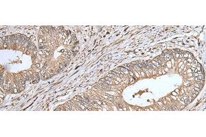 Immunohistochemistry of paraffin-embedded Human colorectal cancer tissue using UQCRQ Polyclonal Antibody at dilution of 1:45(x200) (UQCRQ 抗体)