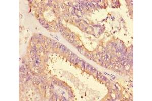 Immunohistochemistry of paraffin-embedded human endometrial cancer using ABIN7143136 at dilution of 1:100