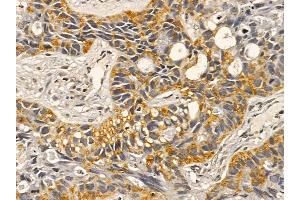 Integrin alpha 3 Mouse Monoclonal Antibody at 1/100 staining human lung cancer and adjacent non-tumor tissue by IHC-P.