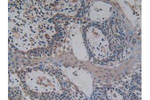 IHC-P analysis of Human Skin Cancer Tissue, with DAB staining. (NFkB 抗体  (AA 805-892))