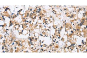 Immunohistochemistry of paraffin-embedded Human thyroid cancer using CKMT2 Polyclonal Antibody at dilution of 1:60 (CKMT2 抗体)
