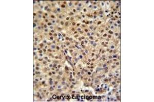 C19orf21 Antibody (N-term) (ABIN651044 and ABIN2840046) IHC analysis in formalin fixed and paraffin embedded human cervix carcinoma followed by peroxidase conjugation of the secondary antibody and DAB staining. (C19orf21 抗体  (N-Term))