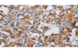 Immunohistochemistry of paraffin-embedded Human thyroid cancer tissue using TSPEAR Polyclonal Antibody at dilution 1:50