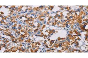 Immunohistochemistry of paraffin-embedded Human thyroid cancer tissue using TSPEAR Polyclonal Antibody at dilution 1:50 (TSPEAR 抗体)