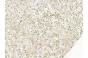 ABIN6264887 and ABIN6276947 at 1/100 staining human astrocytoma by IHC-P.