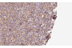 ABIN6273195 at 1/100 staining Human lymph cancer tissue by IHC-P. (SLC10A2 抗体  (C-Term))