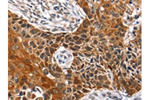 The image on the left is immunohistochemistry of paraffin-embedded Human esophagus cancer tissue using ABIN7129727(HOXB1 Antibody) at dilution 1/40, on the right is treated with fusion protein. (HOXB1 抗体)