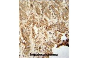 NAT14 antibody (N-term) (ABIN654245 and ABIN2844071) immunohistochemistry analysis in formalin fixed and paraffin embedded human hepatocarcinoma followed by peroxidase conjugation of the secondary antibody and DAB staining. (NAT14 抗体  (N-Term))