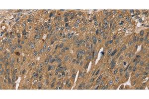 Immunohistochemistry of paraffin-embedded Human breast cancer using SCGB2A1 Polyclonal Antibody at dilution of 1:50 (SCGB2A1 抗体)