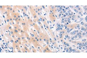 Immunohistochemistry of paraffin-embedded Human lung cancer tissue using MUC2 Polyclonal Antibody at dilution 1:60 (MUC2 抗体)