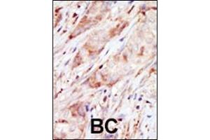 Formalin-fixed and paraffin-embedded human cancer tissue reacted with the primary antibody, which was peroxidase-conjugated to the secondary antibody, followed by AEC staining. (GCK 抗体  (C-Term))
