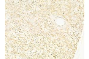 ABIN6261263 and ABIN6278444 at 1/100 staining human astrocytoma by IHC-P.