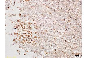 Formalin-fixed and paraffin embedded mouse tumor tissue labeled with Anti-PAX1 Polyclonal Antibody, Unconjugated (ABIN673269) at 1:200 followed by conjugation to the secondary antibody and DAB staining. (PAX1 抗体  (AA 151-250))