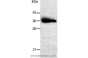 Western blot analysis of Human liver cancer tissue, using PPAP2A Polyclonal Antibody at dilution of 1:650 (PLPP1 抗体)