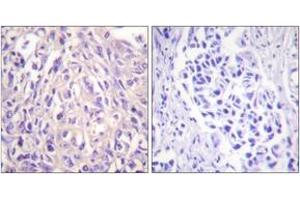 Immunohistochemistry analysis of paraffin-embedded human breast carcinoma tissue, using UBE1L Antibody.