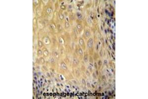 C6orf70 antibody (Center) immunohistochemistry analysis in formalin fixed and paraffin embedded human esophageal carcinoma followed by peroxidase conjugation of the secondary antibody and DAB staining. (C6orf70 抗体  (Middle Region))