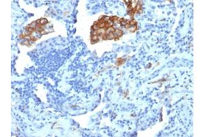 Formalin-fixed, paraffin-embedded human Lung Carcinoma stained with CD209 Mouse Monoclonal Antibody (C209/1781). (DC-SIGN/CD209 抗体)