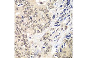 Immunohistochemistry of paraffin-embedded human prostate cancer using RNF2 antibody. (RNF2 抗体  (AA 1-336))
