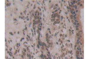 Detection of ENPP2 in Human Stomach cancer Tissue using Monoclonal Antibody to Ectonucleotide Pyrophosphatase/Phosphodiesterase 2 (ENPP2) (ENPP2 抗体  (AA 637-905))