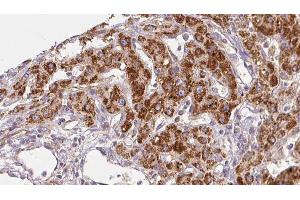 ABIN6278465 at 1/100 staining Human liver cancer tissue by IHC-P. (GABRA1 抗体  (Internal Region))