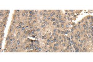 Immunohistochemistry of paraffin-embedded Human liver cancer using TXN Polyclonal Antibody at dilution of 1:40 (TXN 抗体)