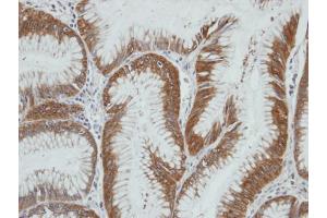 IHC-P Image Immunohistochemical analysis of paraffin-embedded human gastric cancer, using AKR1C4, antibody at 1:100 dilution. (AKR1C4 抗体)