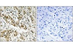 Immunohistochemistry analysis of paraffin-embedded human breast carcinoma tissue, using CtBP1 (Ab-422) Antibody. (CTBP1 抗体  (AA 388-437))