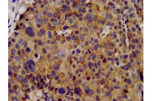 IHC image of ABIN7163969 diluted at 1:300 and staining in paraffin-embedded human pancreatic cancer performed on a Leica BondTM system. (KCNC3 抗体  (AA 638-745))
