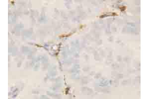 Immunohistochemical staining of ROCK2 on formalin fixed, paraffin embedded human intestinal cancer with ROCK2 polyclonal antibody . (ROCK2 抗体  (N-Term))