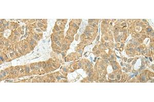 Immunohistochemistry of paraffin-embedded Human thyroid cancer tissue using TENT5C Polyclonal Antibody at dilution of 1:110(x200) (FAM46C 抗体)