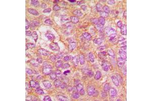 Immunohistochemical analysis of IKK beta (pY188) staining in human breast cancer formalin fixed paraffin embedded tissue section. (IKBKB 抗体  (pTyr188))