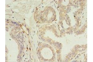 Immunohistochemistry of paraffin-embedded human breast cancer using ABIN7167192 at dilution of 1:100 (RERG 抗体  (AA 1-199))