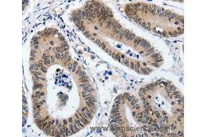 Immunohistochemistry of Human colon cancer using KLF5 Polyclonal Antibody at dilution of 1:120