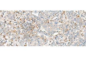 Immunohistochemistry of paraffin-embedded Human cervical cancer tissue using SLC41A3 Polyclonal Antibody at dilution of 1:35(x200) (SLC41A3 抗体)