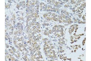 Immunohistochemistry of paraffin-embedded human colon carcinoma using TEFM antibody (ABIN5974873) at dilution of 1/100 (40x lens). (TEFM 抗体)