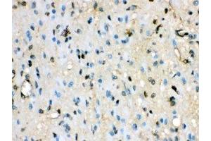 IHC-P: VCP antibody testing of human glioma tissue (VCP 抗体  (AA 732-760))