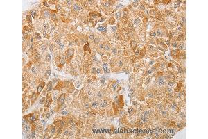 Immunohistochemistry of Human liver cancer using NGF Polyclonal Antibody at dilution of 1:40 (Nerve Growth Factor 抗体)