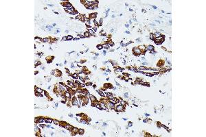 Immunohistochemistry of paraffin-embedded human lung cancer using MMP25 antibody (ABIN7268422) at dilution of 1:100 (40x lens).