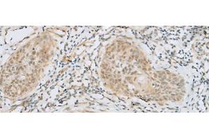 Immunohistochemistry of paraffin-embedded Human esophagus cancer tissue using HELT Polyclonal Antibody at dilution of 1:40(x200) (HELT 抗体)