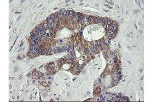 Immunohistochemical staining of paraffin-embedded Adenocarcinoma of Human colon tissue using anti-VBP1 mouse monoclonal antibody. (VBP1 抗体)
