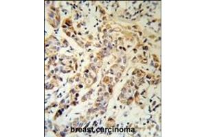 KRT13 Antibody (N-term) (R) IHC analysis in formalin fixed and paraffin embedded human breast carcinoma followed by peroxidase conjugation of the secondary antibody and DAB staining. (Cytokeratin 13 抗体  (N-Term))